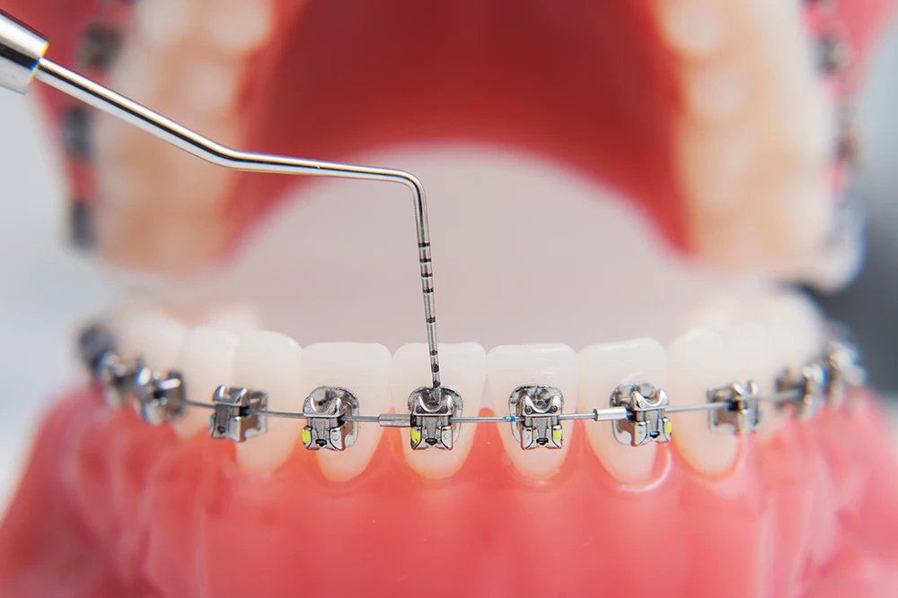 встановлення брекетів в Brillant Dental