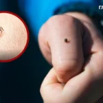Кліщ у дитини: як діяти, поради та профілактика від київської лікарки