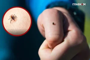 Кліщ у дитини: як діяти, поради та профілактика від київської лікарки